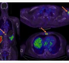  Blue Earth Diagnostics, a leading molecular imaging diagnostics company, today announced that their manufacturing partner Nucleis (Liege, Belgium) has manufactured and shipped their first patient doses of rhPSMA-7.3 (18F), an investigational Prostate-Specific Membrane Antigen (PSMA)-targeted radiohybrid PET imaging agent, currently under evaluation in clinical trials in men with newly diagnosed prostate cancer and suspected prostate cancer recurrence.