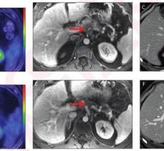Post-neoadjuvant therapy changes in metabolic metrics from PET/MRI and morphologic metrics from CT were associated with pathologic response and overall survival in patients with pancreatic ductal adenocarcinoma