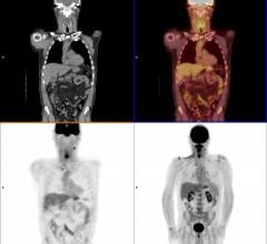 FDG-PET/CT Predicts Melanoma Patients' Response to Immune Checkpoint Inhibitor Therapy