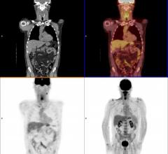 Halving Radiotherapy for HPV-Related Throat Cancer Reduces Side Effects With Similar Control Rates