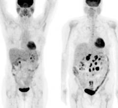 PET, Hodgkin lymphoma, chemotherapy, remission, U.S. trial