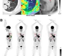 A performance evaluation of the uEXPLORER total-body PET/CT scanner showed that it exhibits ultra-high sensitivity that supports excellent spatial resolution and image quality. Given the long axial field of view (AFOV) of the uEXPLORER, study authors have proposed new, extended measurements for phantoms to characterize total-body PET imaging more appropriately. This research was published in the June issue of The Journal of Nuclear Medicine.