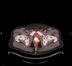 POSLUMA (flotufolastat F 18) PET/CT image showing uptake in the prostate gland, consistent with primary prostate cancer.