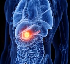 Updated Guideline on Radiation Therapy for Pancreatic Cancer Now Available