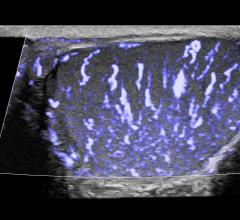  Philips-MicroFlow-Imaging-testicular-ultrasound