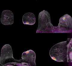 PET Scans Show Biomarkers Could Spare Some Breast Cancer Patients from Chemotherapy