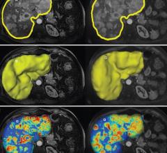 Liver cancer advanced imaging. Webinar will cover new advances for more precise targeting of Liver Cancer.