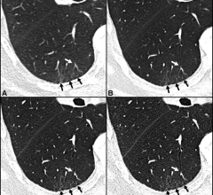 Ultra-high-resolution photon-counting CT reveals bronchiolectasis: Axial CT lung images without contrast agent of a 70-year-old woman with persistent fatigue 401 days after COVID-19: 1.0mm image obtained with energy-integrating detector (EID) CT (A), and 1.0mm (B), 0.4mm (C) and 0.2mm (D) images obtained with photon-counting detector CT at the same level. Bronchiolectasis (white arrow) was not detected by EID CT but was found by PCD-CT. Ground-glass opacity detected in EID CT images (black arrows in A) was 