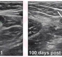 Lymph node measurements in 33-year-old woman for bilateral screening breast ultrasound. 