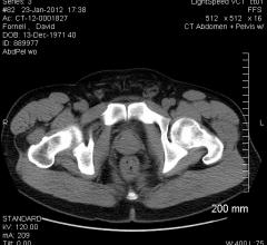 OSUCCC, prostate cancer, miRNA, recurrence, radiation therapy