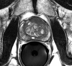 Radiation therapy, ASTRO, clinical trial/study, prostate cancer