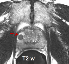 Prostate Cancer Czech Proton Therapy Center Diagnosis Treatment