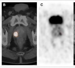 PSMA PET-CT Clearly Differentiates Prostate Cancer from Benign Tissue