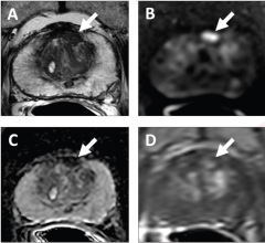 62-year-old with serum PSA level of 4.11 ng/mL. Prostate MRI shows lesion in left mid anterior transition zone 