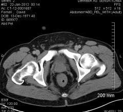 prostate, CT scan, Dave Fornell medical