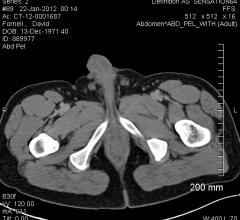 prostate cancer, stereotactic body radiation therapy, SBRT, cure rate, UT Southwestern Study