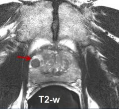 prostate cancer, partial gland, SBRT, clinical trial, UH Hospitals