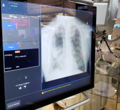 SIIM and ACR Host Machine Learning Challenge for Pneumothorax Detection and Localization
