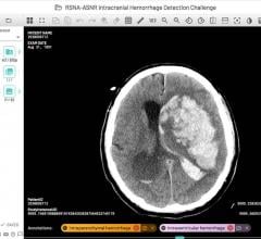 A complex multicompartmental cerebral hemorrhage on a single axial CT image displayed using the annotation tool in a single portal window. Hemorrhage labels (left column) relevant to the image display on the bottom of the image once selected. ASNR = American Society of Neuroradiology RSNA = Radiological Society of North America.
