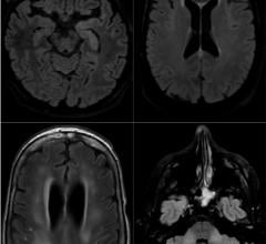 Axial FLAIR in four different COVID-19 patients. A) 58-year old man with impaired consciousness: FLAIR hyperintensities located in the left medial temporal lobe. B) 66-year old man with impaired consciousness: FLAIR ovoid hyperintense lesion located in the central part of the splenium of the corpus callosum. C) 71-year old woman with pathological wakefulness after sedation: extensive and confluent supratentorial white matter FLAIR hyperintensities (arrows). Association with leptomeningeal enhancement (stars