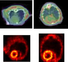 PET Imaging Shows Protein Clumping May Contribute to Heart Failure Development
