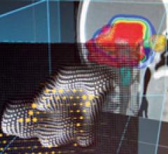 First European Patient Treated with RayStation Treatment Planning System