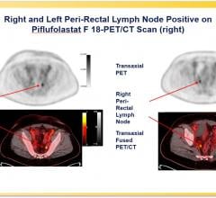 A phase III clinical trial has validated the effectiveness of the prostate-specific membrane antigen (PSMA)-targeted radiotracer 18F-DCFPyL in detecting and localizing recurrent prostate cancer. 