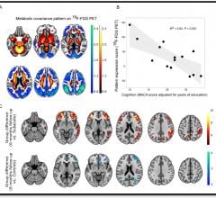 SNMMI's Image of the Year is a detailed depiction of areas of cognitive impairment, neurological symptoms and comparison of impairment over a six-month time frame