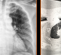 White Medial Clavicle Head: Fig. 1—Sclerosis involving the first anterior costochondral junction, secondary to degenerative changes, is a common finding. In this case, appearance was asymmetric and revelated to be overlapping lung cancer.