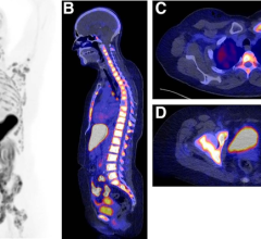 Determination of ER status of disease. In 59-y-old woman diagnosed with ER-positive lobular BC 2 y previously and treated with tamoxifen, ER-positive bone metastases were identified 1 y after initial diagnosis.