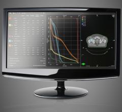 Varian, RapidPlan, radiotherapy, radiation therapy, U.K., treatment planning 