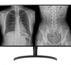 LG’s new 8-megapixel radiology monitor (model 32HL512D – FDA 510k Class II approval is pending) has a larger screen than its 27-inch predecessor and employs LG NanoCell IPS display technology for image quality optimized for accurate reviews