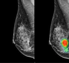 Mammograms of a 49-year-old woman with invasive lobular carcinoma on the right-side breast