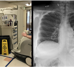 Chest radiography through glass. A, Technologists position the portable x-ray unit outside the patient room, with the tube peering through the mesh wire–reinforced isolation room window. B, Anteroposterior chest radiograph obtained is of diagnostic quality. 