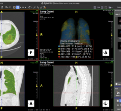 These solutions, the Lung Density Analysis II (LDA-II) workflow for Intuition and the Emergency Lung AI Suite, provide two deployment options for rapid access to lung segmentation and quantification tools that can be applied to a wide range of lung illnesses and have been optimized to adapt to the latest disease presentation states