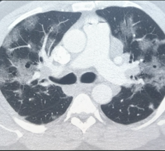 COVID-19 patient CT scan showing numerous ground glass lesions associated with SARS-CoV-2 pneumonia. 