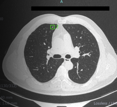 Infervision's newly FDA approved CT lung AI application sets a new standard
