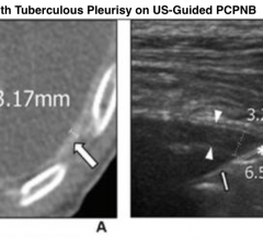 Enhanced axial CT (A) shows diffuse pleural thickening (arrow) with a maximum thickness of 3.17 mm. US image for the corresponding lesion on CT (B) shows diffuse pleural thickening (arrowheads) with a maximum thickness of 3.25 mm. The needle pathway length, measured as the needle length through the pleural lesion, was 6.54 mm (asterisk). Pleural puncture angle (exact value not indicated) is depicted as the angle between the outer line of the pleura and the biopsy needle (thin arrow).