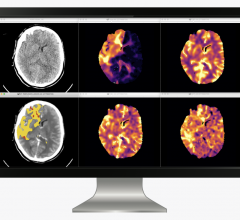 icobrain cva allows the quantitative assessment of tissue perfusion by reporting the volume of core and perfusion lesion by quantifying Tmax abnormality and CBF abnormality together with the mismatch volume and ratio