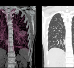 Patients with primary lung cancer detected using low-dose computed tomography screening are at reduced risk of developing brain metastases after diagnosis, according to a study published in the Journal of Thoracic Oncology.