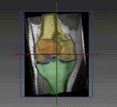 The software provides fully automated precise segmentation and robust assessment of chondral lesions (location, diameter, shape, boundaries), resulting in improved diagnosis and treatment selection, supporting faster recovery