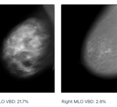 Right mediolateral oblique (MLO) mammograms for different women with the same breast thickness but varying breast density.