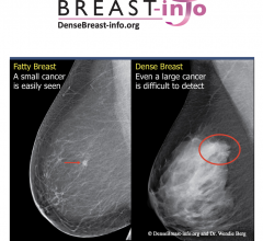 DenseBreast-info.org (DB-I) announced that the European Society of Radiology (ESR) now links to DB-I website and educational materials as a resource for members about the screening and risk implications of dense breast tissue.