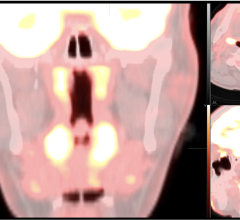 The Task Force members have recently observed an unusual imaging pattern on FDG PET/CT or FDG PET/MR that may be due to COVID-19 infection. 