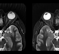 Extending deep learning-based AIR Recon DL compatibility to 3D and PROPELLER has the potential to enable more confident patient diagnoses in MRI 