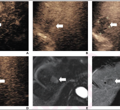 71-year-old woman at high-risk for HCC due to chronic hepatitis B. Patient underwent CEUS using perfluorobutane. (A) Arterial-phase CEUS image (12 seconds after injection) shows 25-mm segment-8 lesion with nonrim hyperenhancement (arrow). (B) CEUS image in portal-venous phase (48 seconds) shows corresponding early washout (arrow). (C) CEUS image in late phase (2 minutes) shows corresponding late and mild washout (arrow). (D) CEUS image in Kupffer phase (15 minutes) shows marked Kupffer defect (arrow). Patie