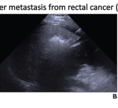 Metastasis was treated by upfront microwave ablation (MWA) and adjuvant systemic therapy (six cycles of FOLFIRI plus Bevacizumab). A. Axial contrast-enhanced T1-weighted MR image obtained before treatment shows 32x29x37-mm target lesion in segment V (arrow). B. Ultrasound image obtained during ultrasound-guided MWA shows hyperechogenicity around target lesion, corresponding with heat energy from ablation antennas. C. Axial contrast-enhanced T1-weighted MR image obtained 1 month after MWA shows 56x49x52-mm r
