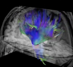 Diffusion tensor imaging, an MRI technique, of the brain.