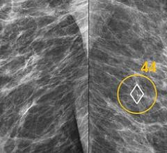 Transpara Deep Learning Software Matches Experienced Radiologists in Mammogram Reading