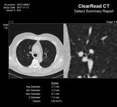 The U.S. Department of Veterans Affairs has selected Riverrain’s ClearRead CT AI-powered technology as part of its Lung Precision Oncology Program.  